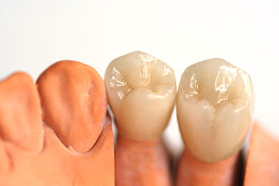 Dental Crowns 01462