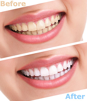 Teeth Whitening in Lunenburg